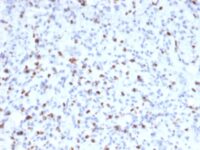 FFPE human rhabdomyosarcoma sections stained with 100 ul anti-Myogenin (clone MYOG/2660) at 1:100. HIER epitope retrieval prior to staining was performed in 10mM Citrate, pH 6.0.